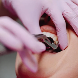 A Guide to Pain-Free Tooth Extractions in Garden City