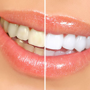 How Cosmetic Dentistry Do Teeth Whitening? | Garden City