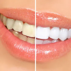 How Cosmetic Dentistry Do Teeth Whitening? | Garden City How Cosmetic Dentistry Do Teeth Whitening? | Garden City