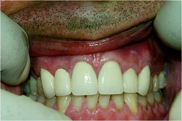 Dental Crowns After 