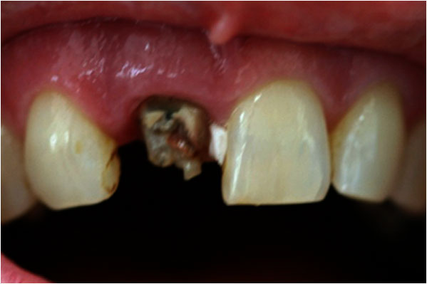 Dental Implants Bofore