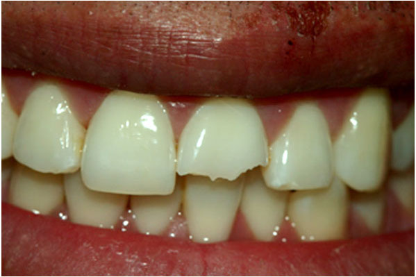 Dental Crowns Before 